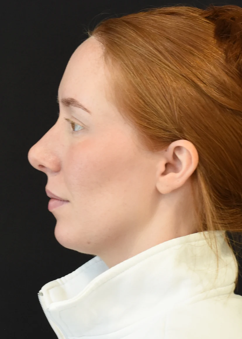 Rhinoplasty Patient 8 Set3 After